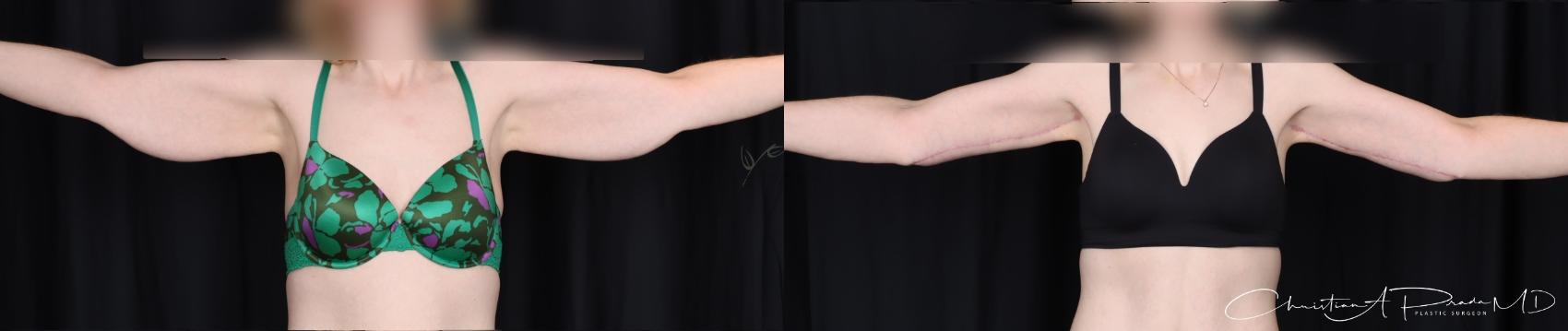 Anterior Brachioplasty with Dr. Prada