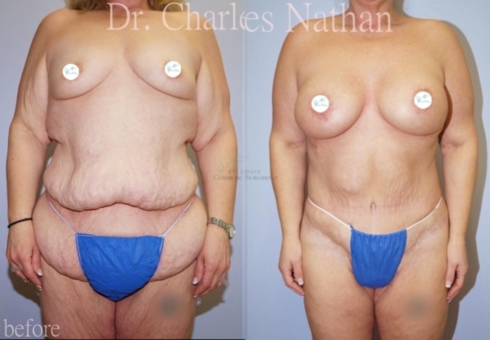 Before & After Body Lift Case 445 Front View in St. Louis, MO