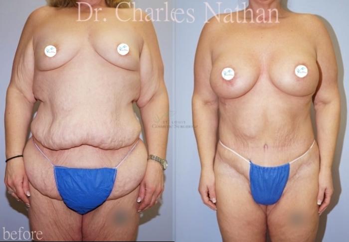 Before & After Body Lift Case 445 Front View in St. Louis, MO