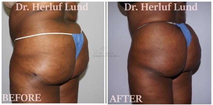 Before & After Brazilian Butt Lift Case 426 Left Oblique View in St. Louis, MO