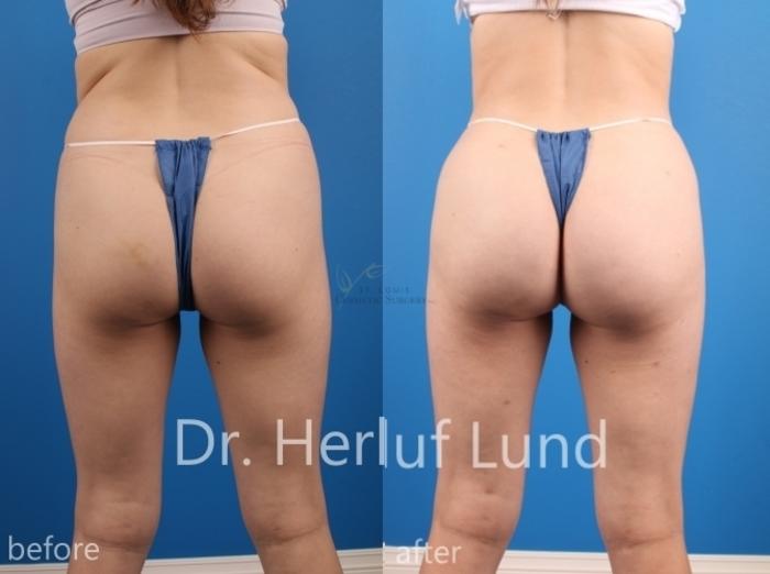 Before & After Brazilian Butt Lift Case 452 Front View in St. Louis, MO