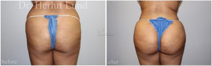 Before & After Brazilian Butt Lift Case 456 Front View in St. Louis, MO