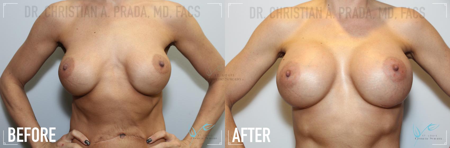 Before & After Breast Augmentation Case 124 Front View in St. Louis, MO