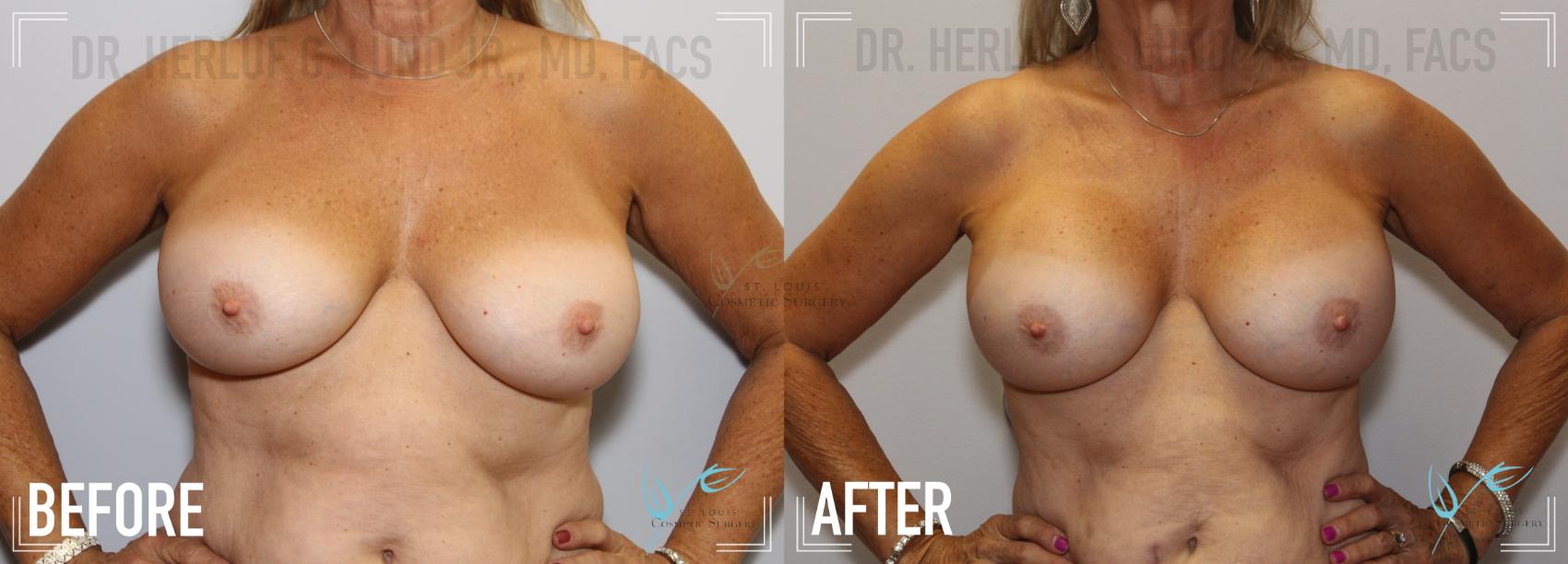 Before & After Breast Augmentation Case 132 Front View in St. Louis, MO