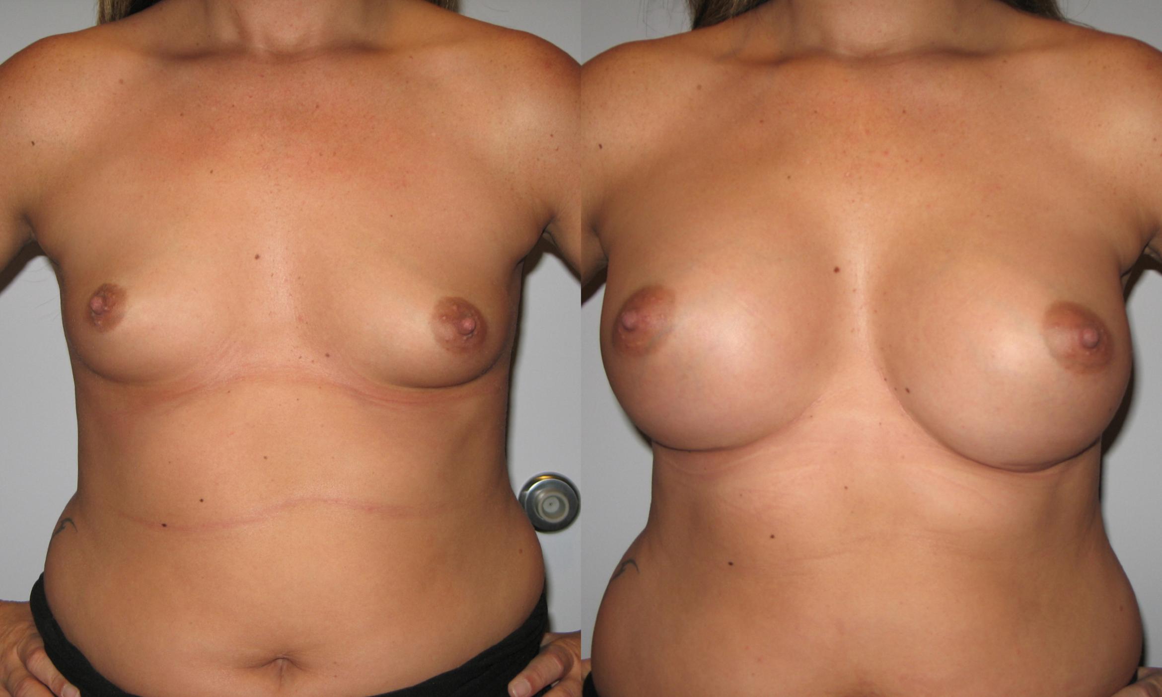 Breast Augmentation Before & After Photo | St. Louis, MO | St. Louis Cosmetic Surgery