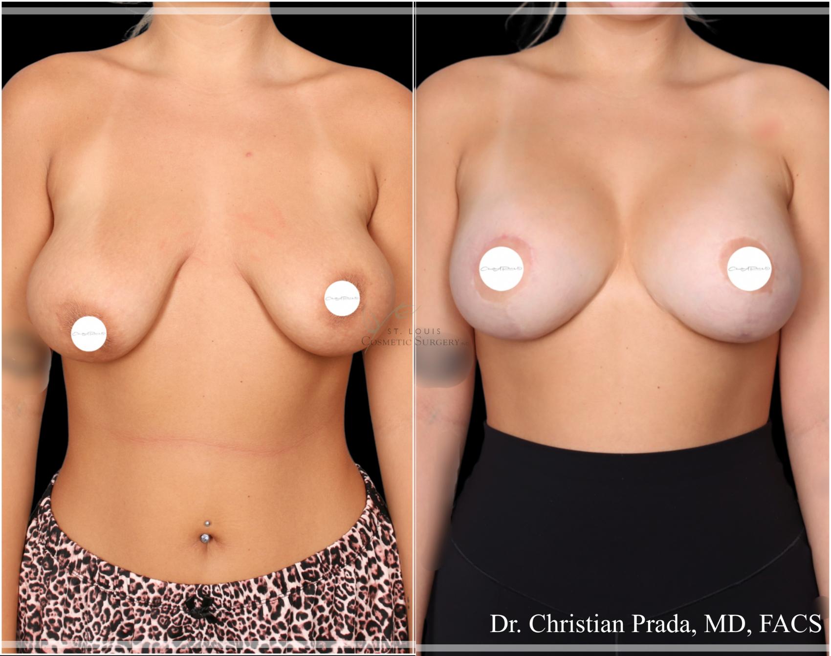 Before & After Breast Lift Case 407 Front View in St. Louis, MO