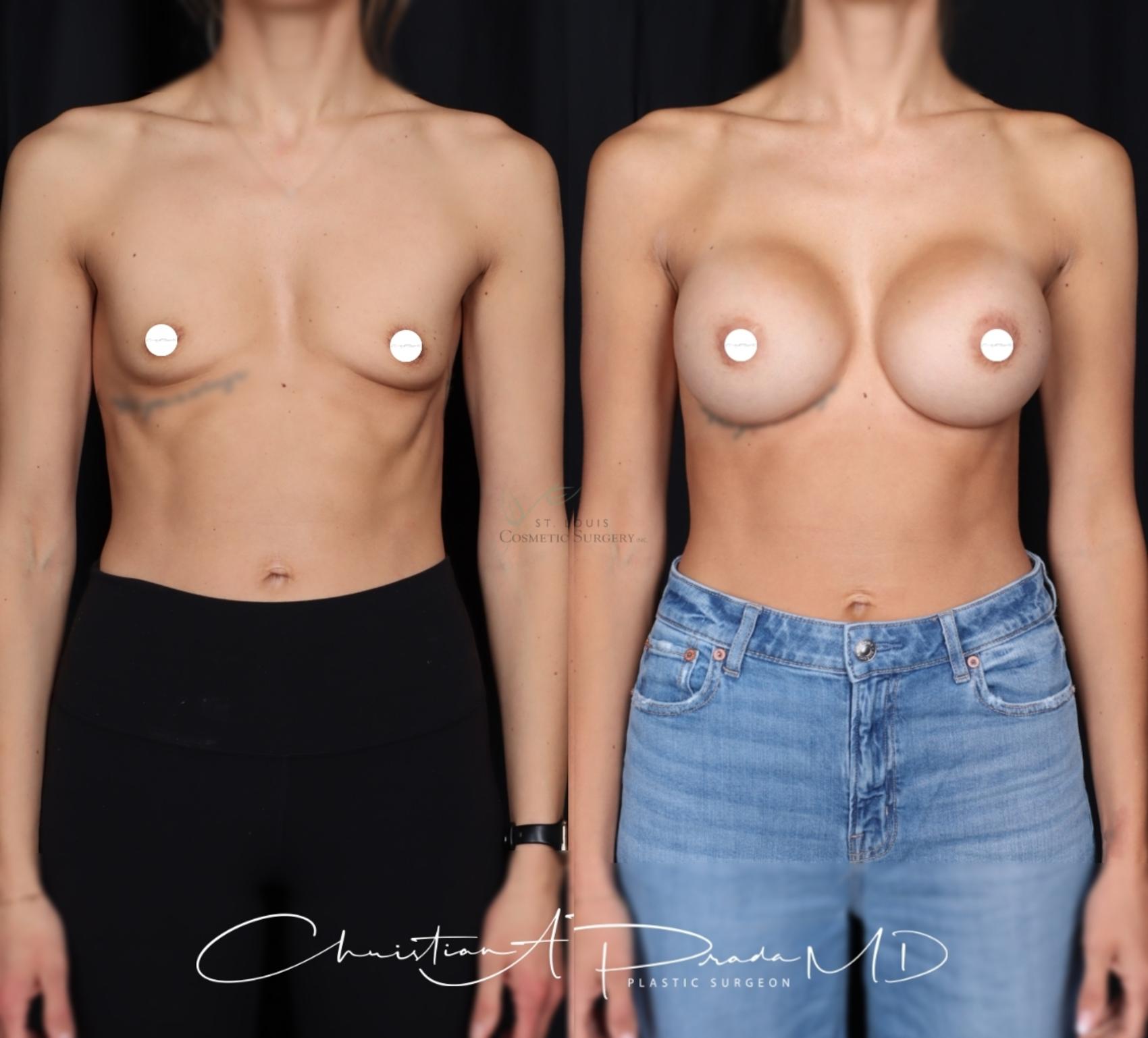 Before & After Breast Augmentation Case 412 Front View in St. Louis, MO