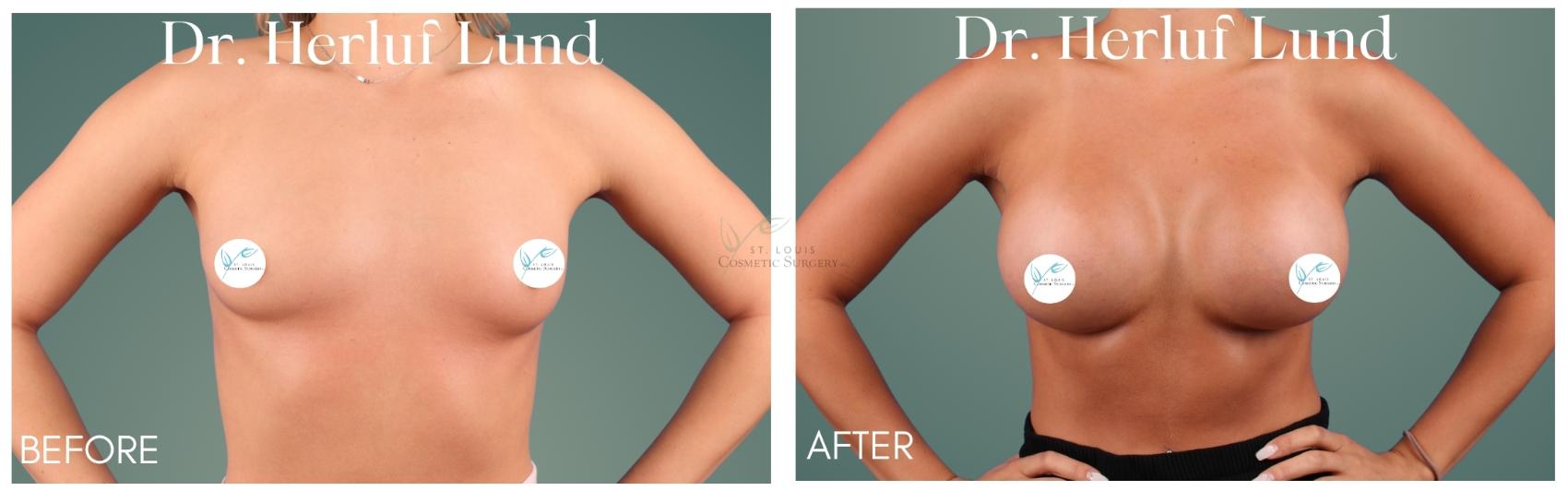 Before & After Breast Augmentation Case 413 Front View in St. Louis, MO