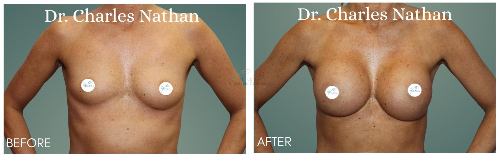 Before & After Breast Augmentation Case 414 Front View in St. Louis, MO