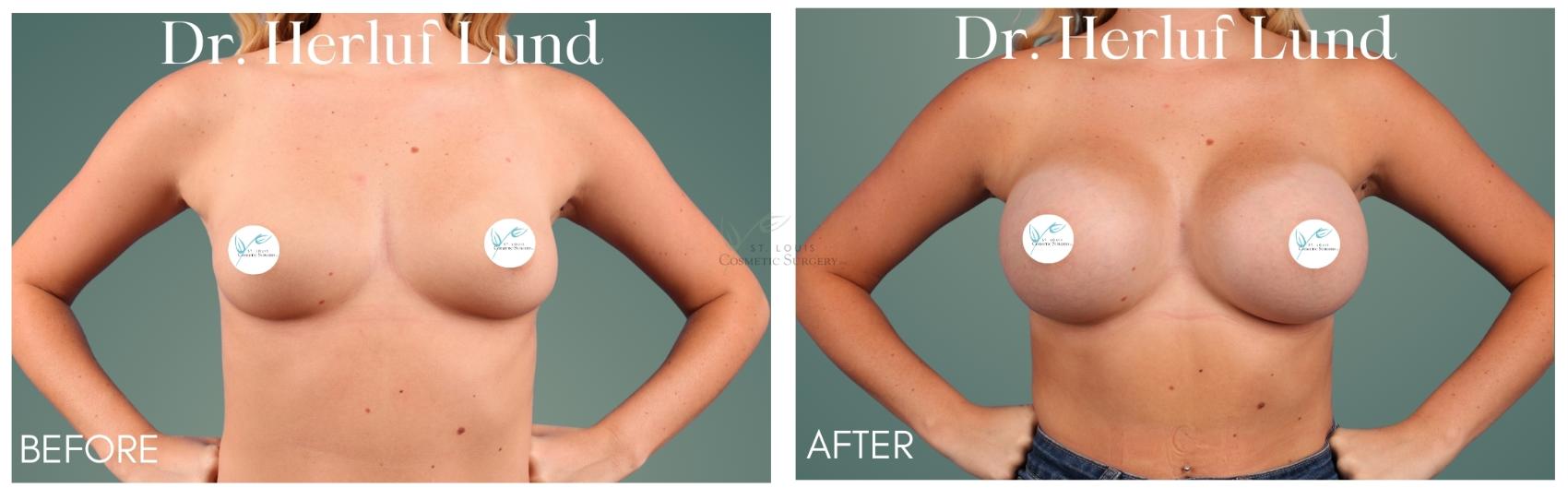 Before & After Breast Augmentation Case 415 Front View in St. Louis, MO