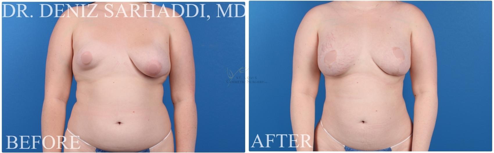 Before & After Breast Augmentation Case 422 Front View in St. Louis, MO