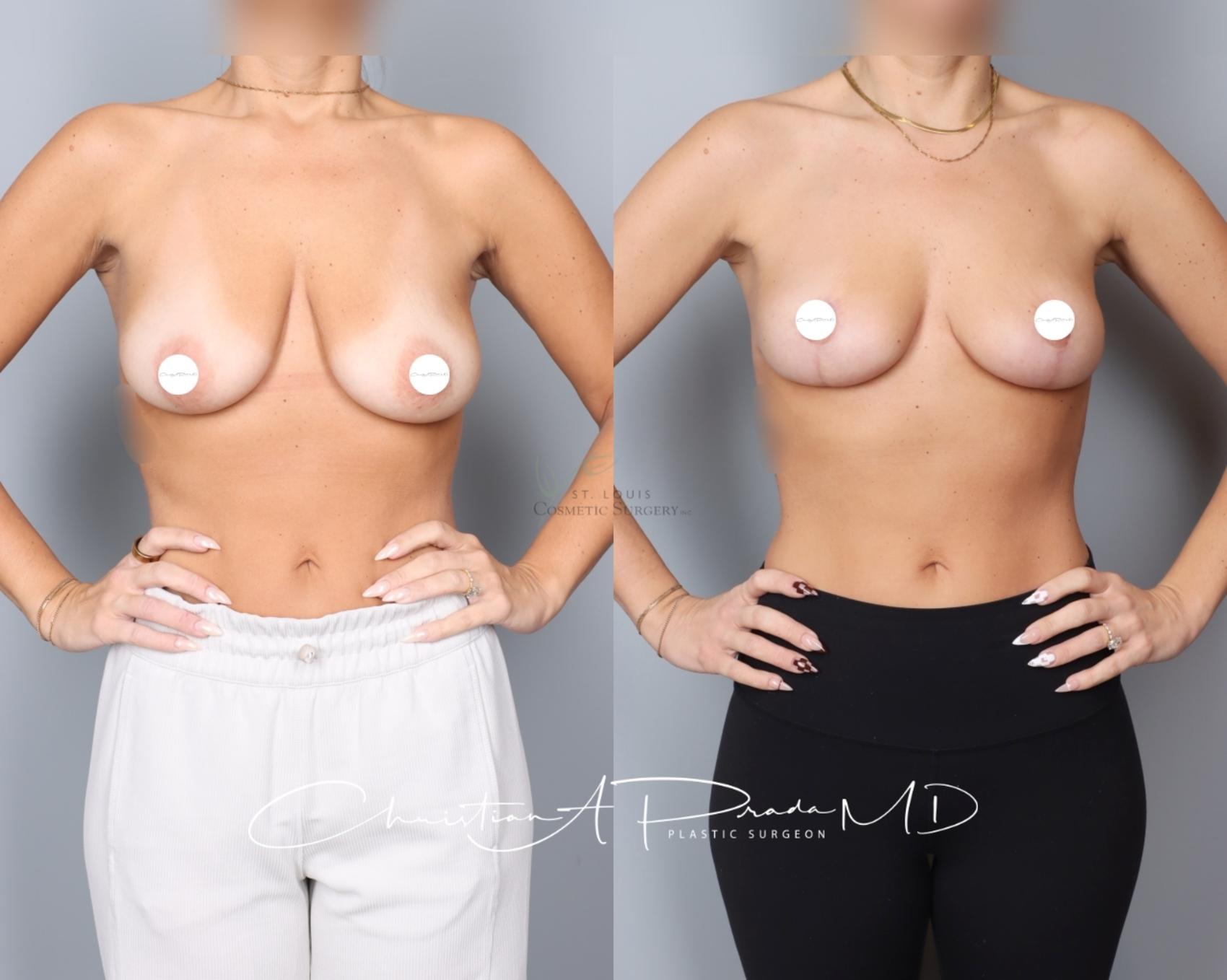 Before & After Breast Lift Case 401 Front View in St. Louis, MO