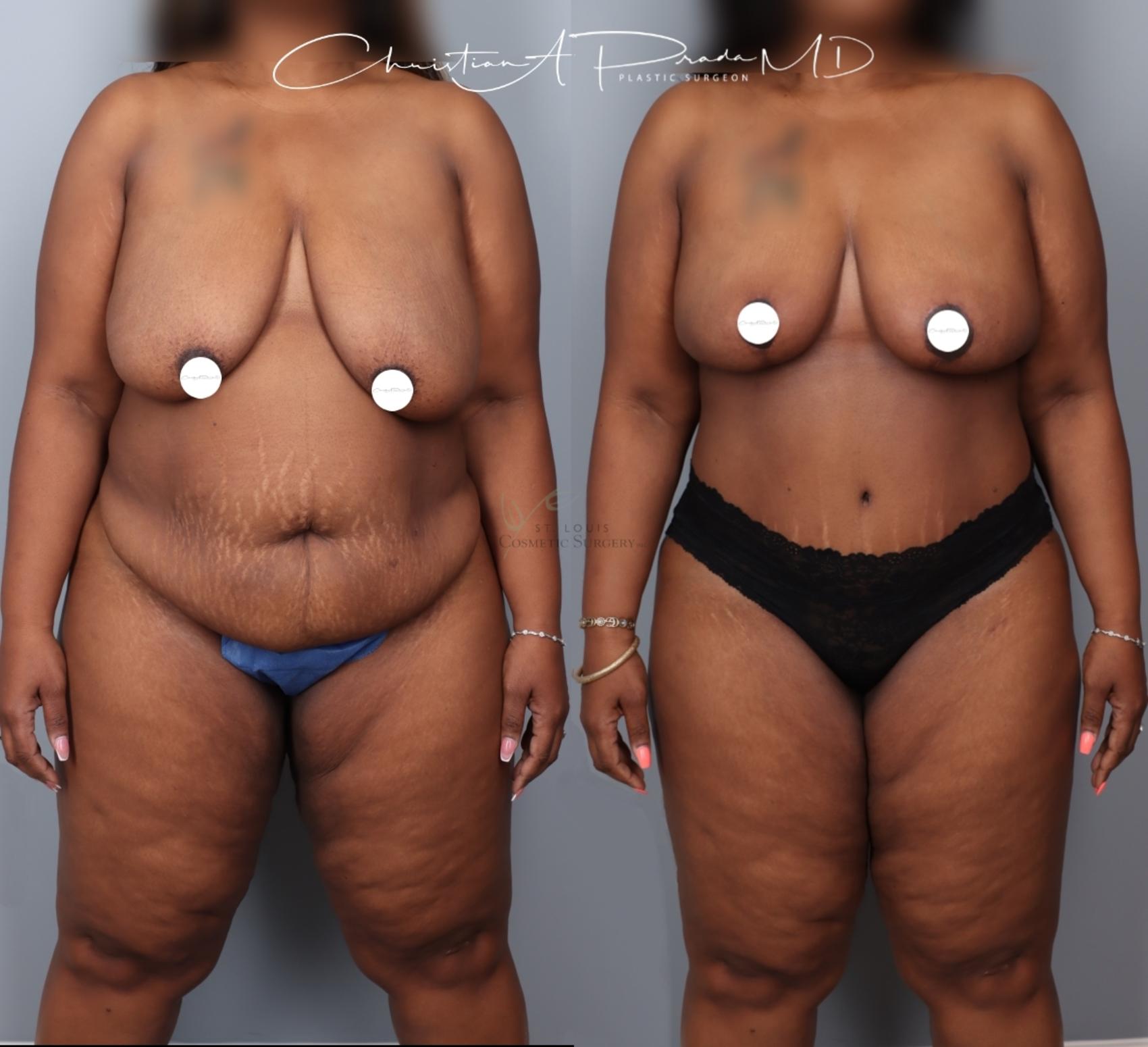 Before & After Breast Reduction Case 404 Front View in St. Louis, MO