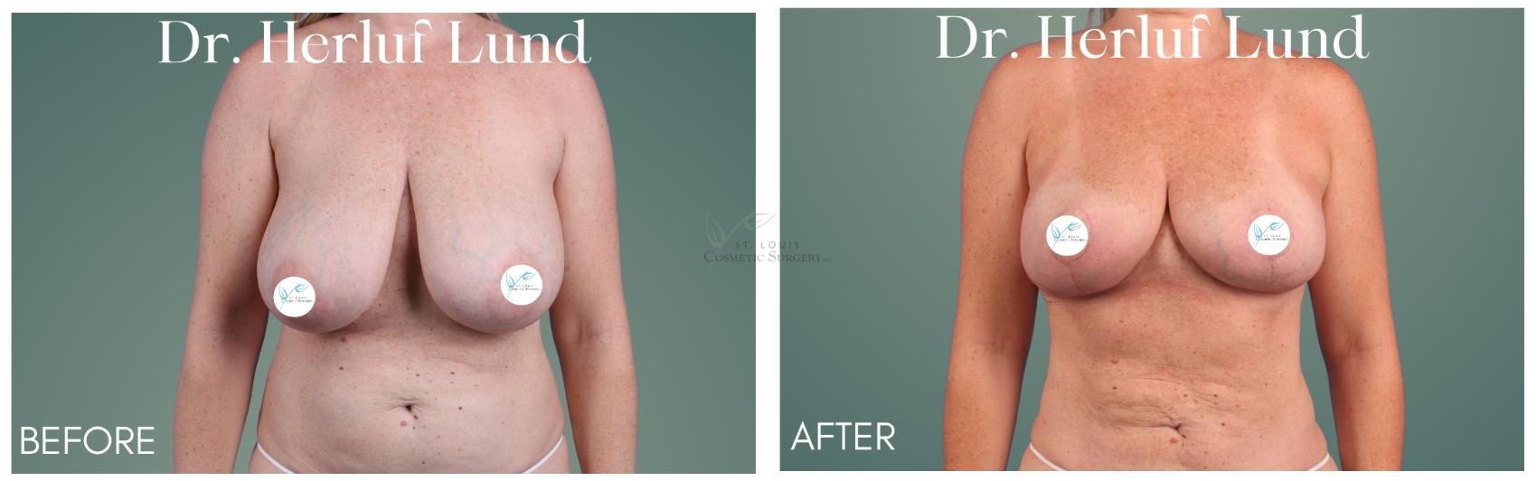 Before & After Breast Reduction Case 409 Front View in St. Louis, MO