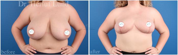 Before & After Breast Reduction Case 454 Front View in St. Louis, MO