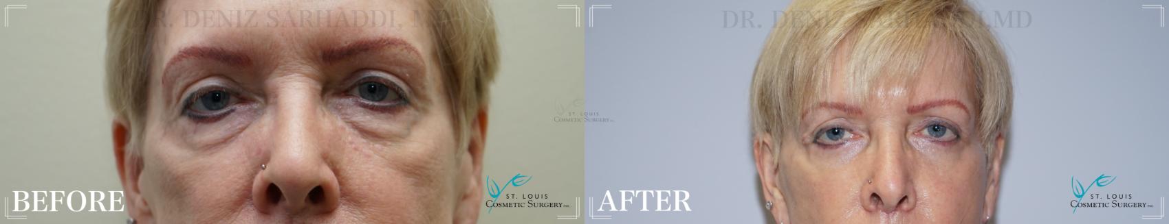 Before & After Eyelid Surgery Case 186 Front View in St. Louis, MO