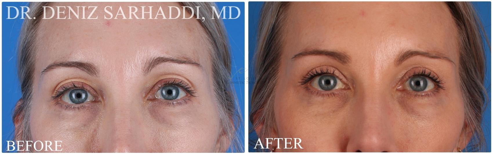 Before & After Eyelid Surgery Case 420 Front View in St. Louis, MO