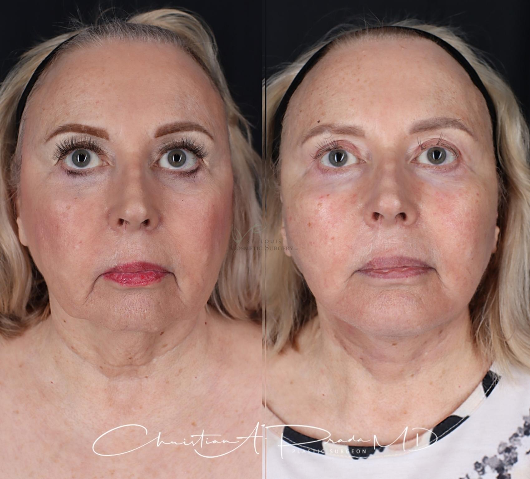 Before & After Facelift Case 411 Front View in St. Louis, MO