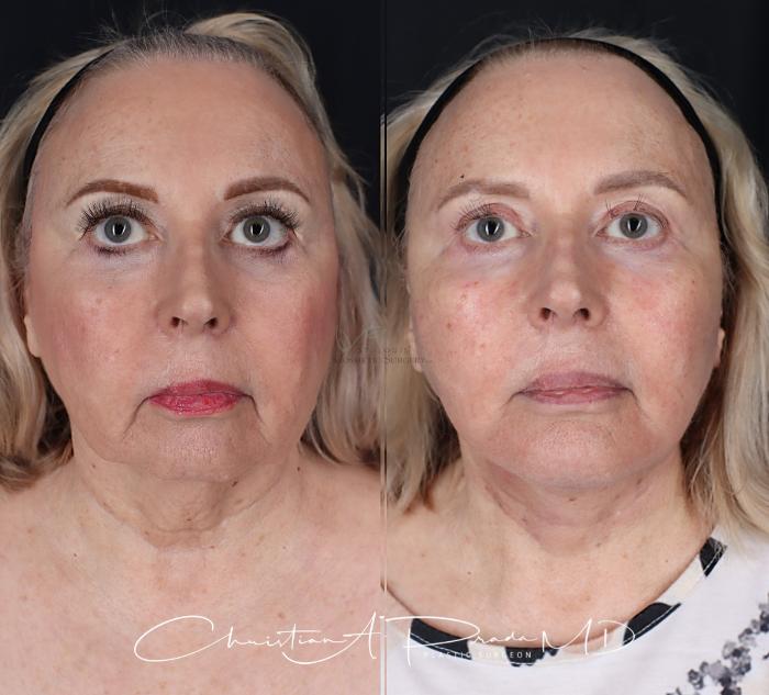 Before & After Chin Enhancement Case 411 Front View in St. Louis, MO