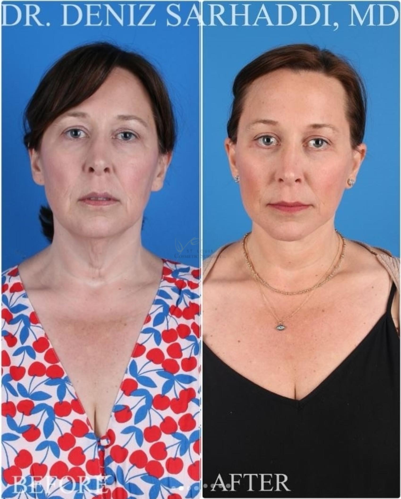 Before & After Facelift Case 417 Front View in St. Louis, MO