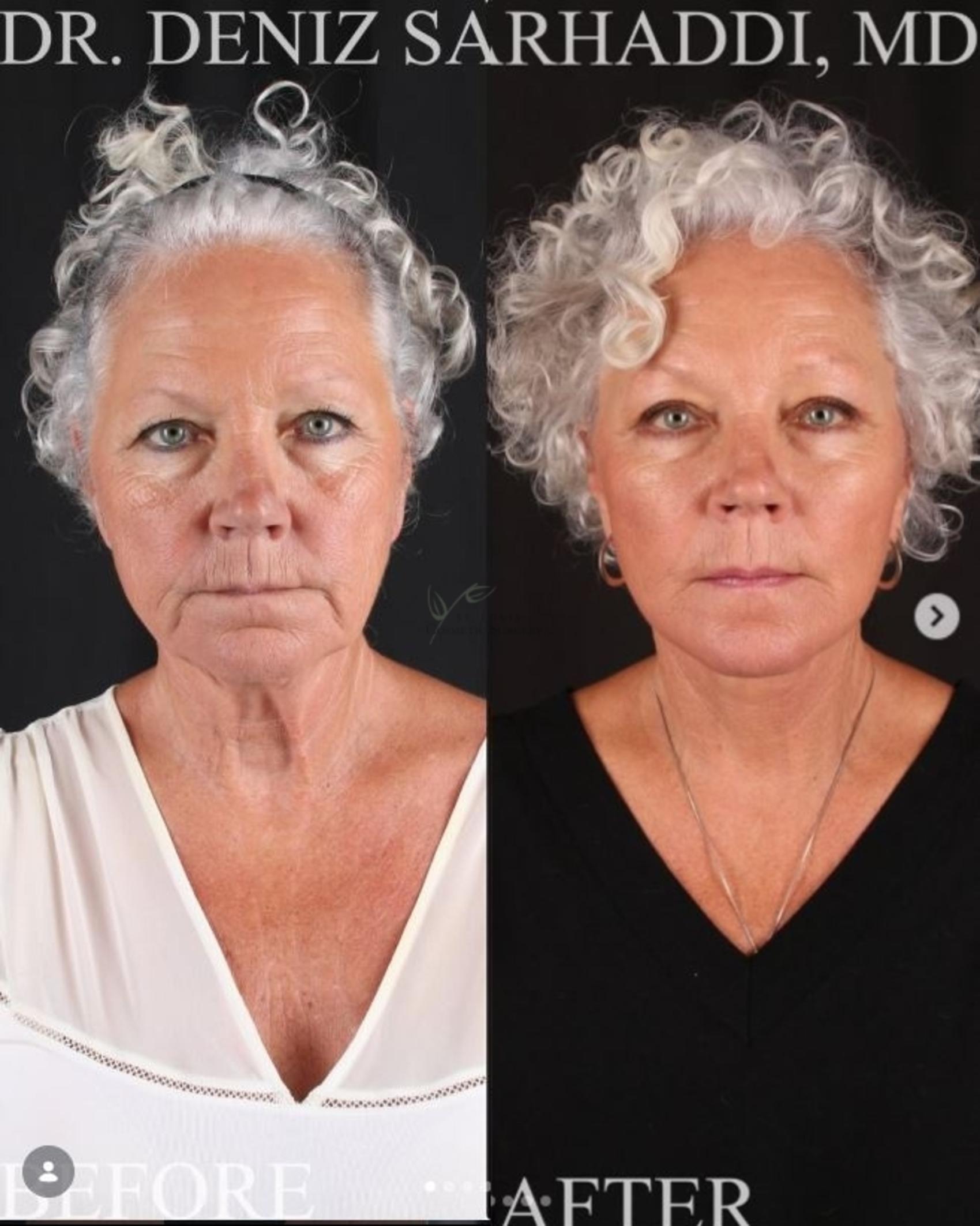 Before & After Facelift Case 467 Front View in St. Louis, MO