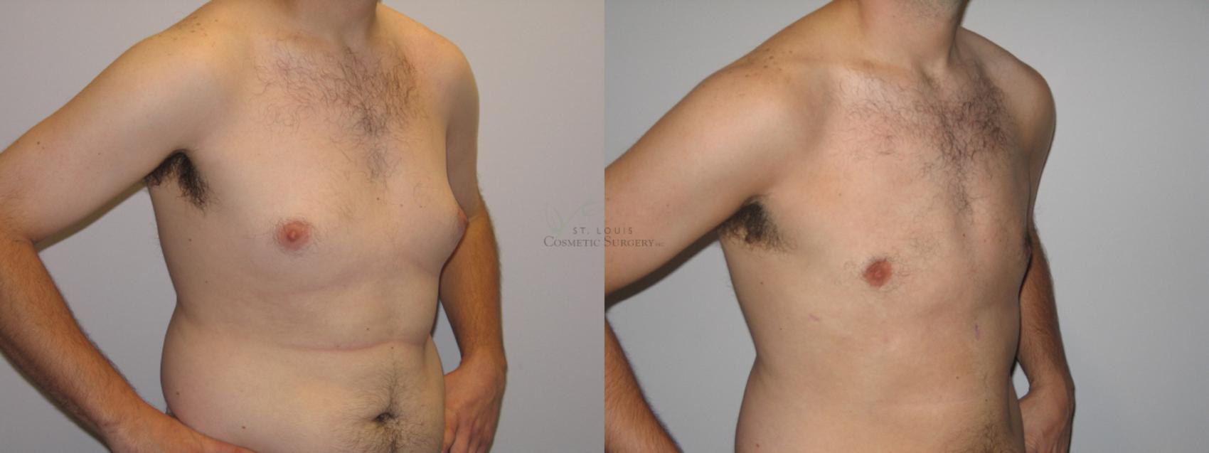 Before & After Male Breast Reduction Case 1 View #2 View in St. Louis, MO