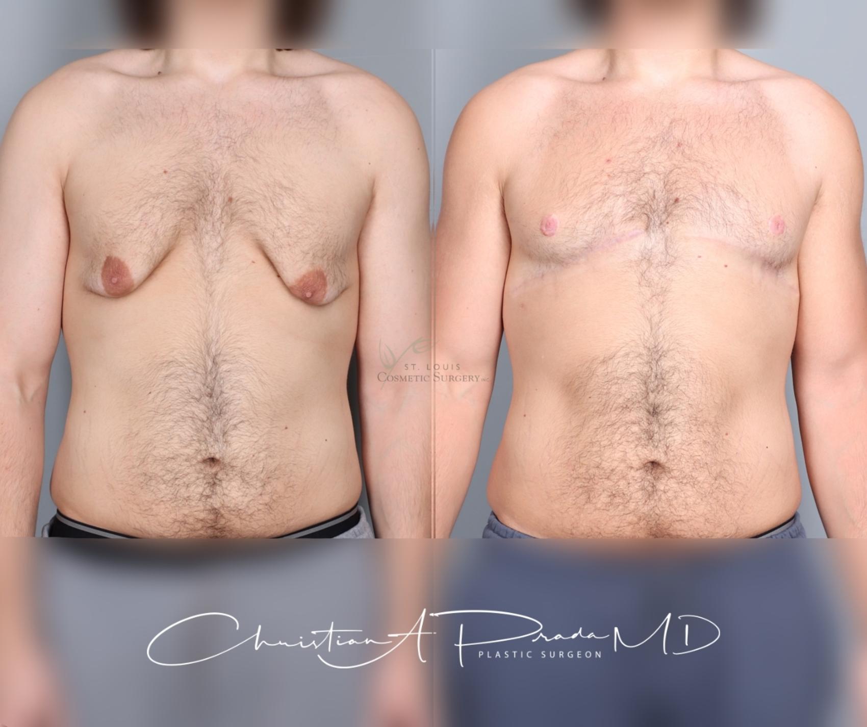 Before & After Male Breast Reduction Case 458 Front View in St. Louis, MO