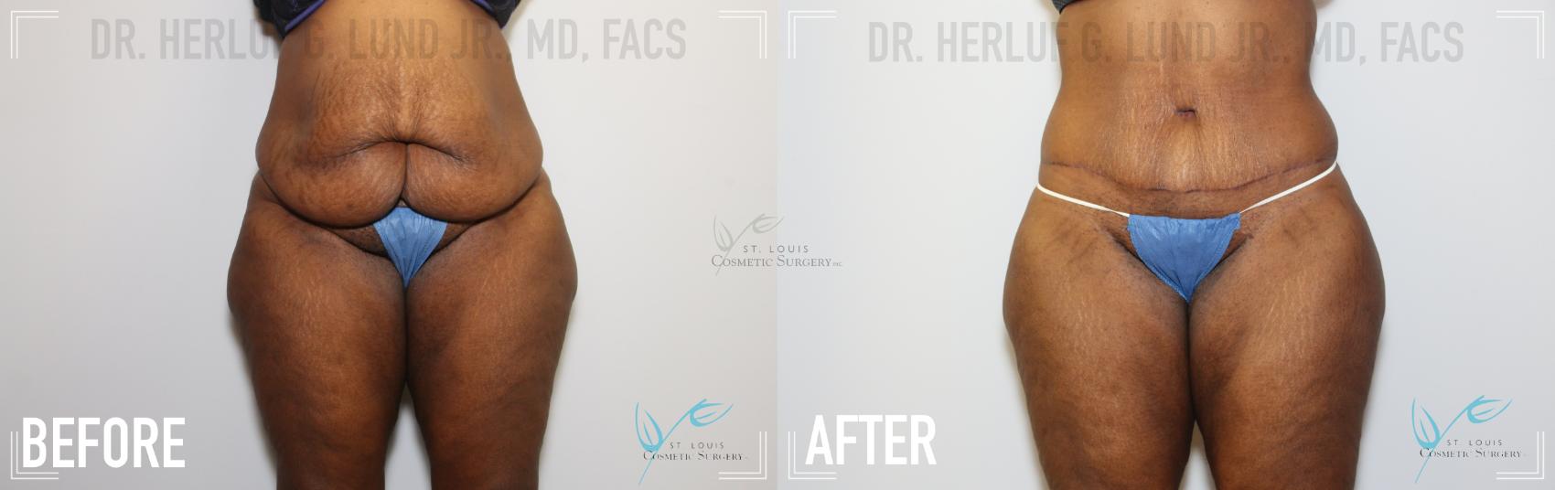 Before & After Tummy Tuck Case 147 Front View in St. Louis, MO