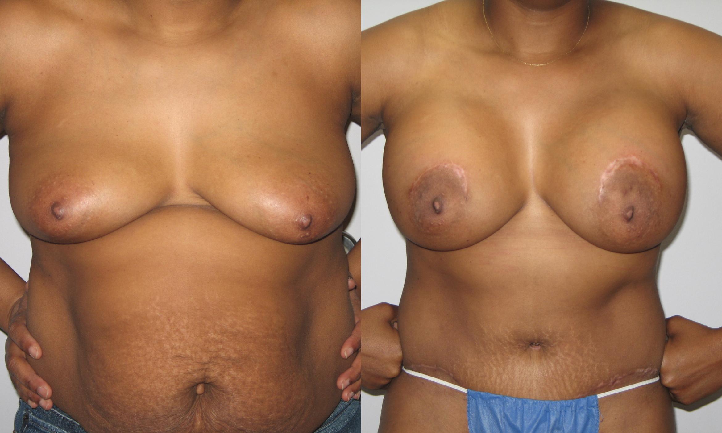 Tummy Tuck Before & After Photo | St. Louis, MO | St. Louis Cosmetic Surgery