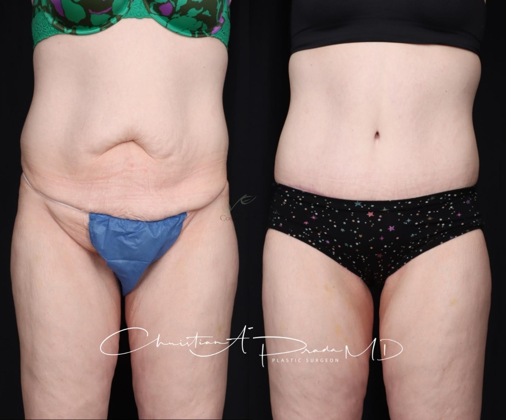 Before & After Tummy Tuck Case 400 Front View in St. Louis, MO
