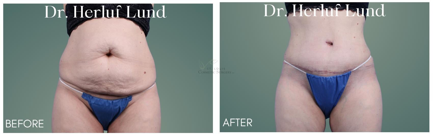 Before & After Tummy Tuck Case 410 Front View in St. Louis, MO