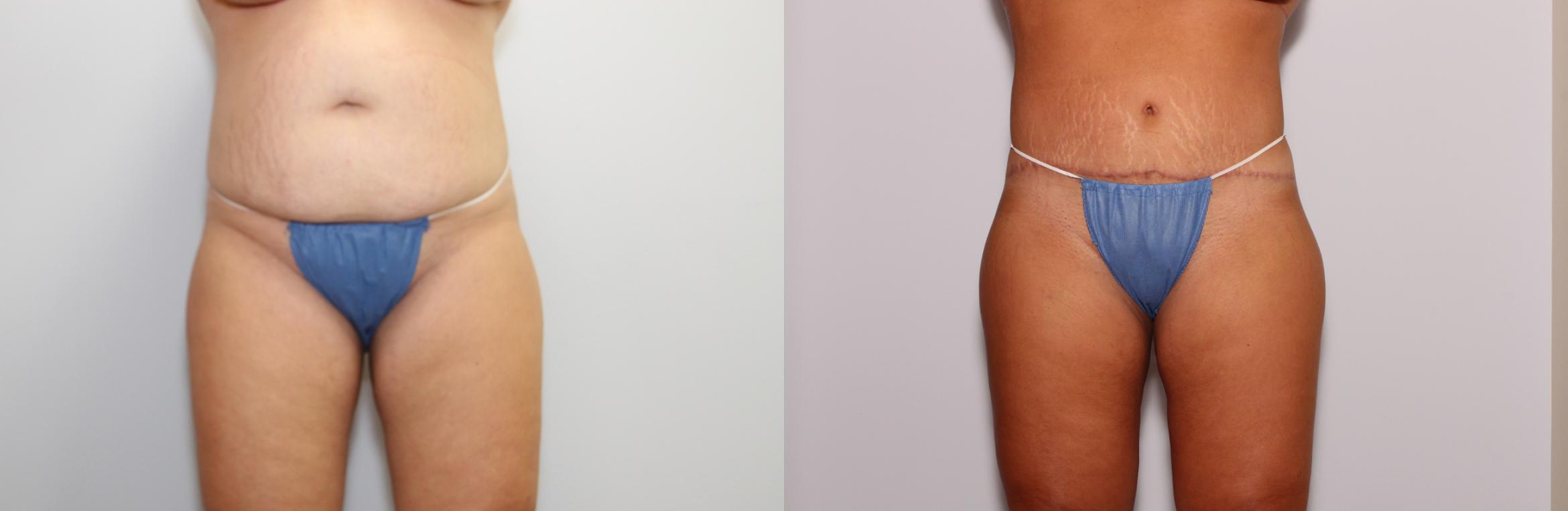 Tummy Tuck Before & After Photo | St. Louis, MO | St. Louis Cosmetic Surgery
