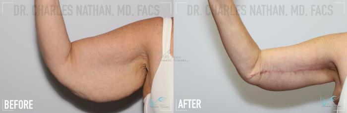 Before & After Arm Lift Case 168 Right Arm- Bent View in St. Louis, MO
