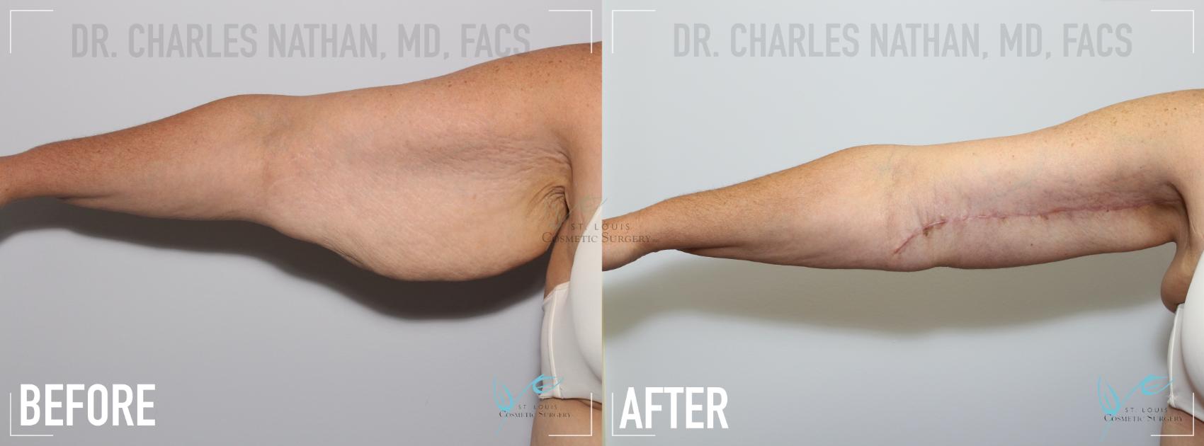 Arm Lift Before & After Photo | St. Louis, MO | St. Louis Cosmetic Surgery