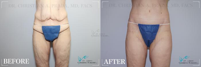 Before & After Arm Lift Case 179 FRONT- Abdominoplasty View in St. Louis, MO