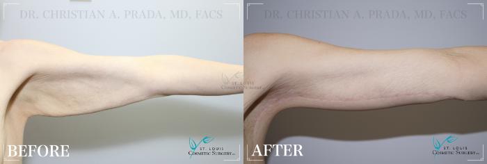 Before & After Arm Lift Case 179 Left Side View in St. Louis, MO