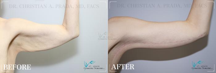 Before & After Tummy Tuck Case 179 Right Side- Bent View in St. Louis, MO