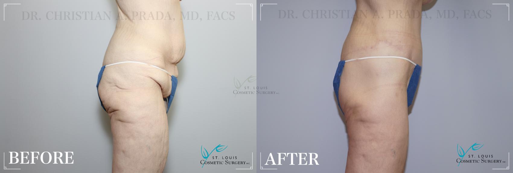 Arm Lift Before & After Photo | St. Louis, MO | St. Louis Cosmetic Surgery