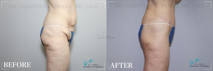Before & After Arm Lift Case 179 Side- Abdominoplasty View in St. Louis, MO