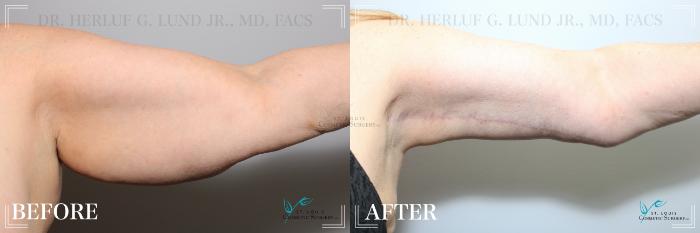 Before & After Arm Lift Case 199 Left Side View in St. Louis, MO