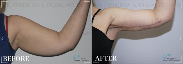 Before & After Arm Lift Case 321 View #1 View in St. Louis, MO