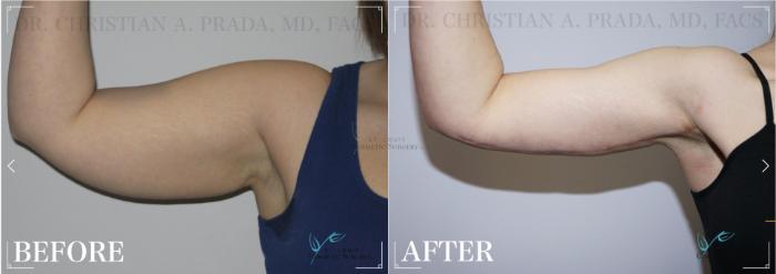 Before & After Arm Lift Case 321 View #2 View in St. Louis, MO