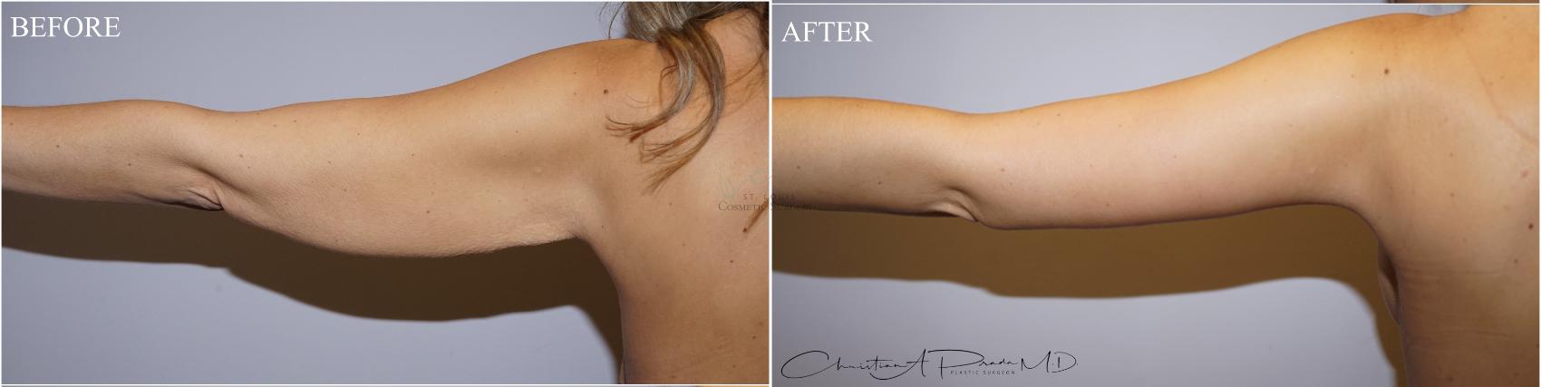 Before & After Arm Lift Case 370 Front View in St. Louis, MO