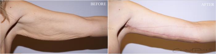 Before & After Arm Lift Case 370 Left Anterior Arm View in St. Louis, MO