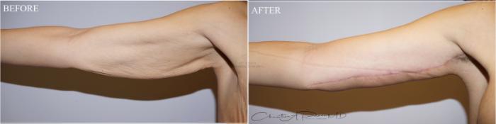 Before & After Arm Lift Case 370 Right Anterior Arm View in St. Louis, MO