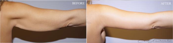 Before & After Arm Lift Case 370 Right Side View in St. Louis, MO