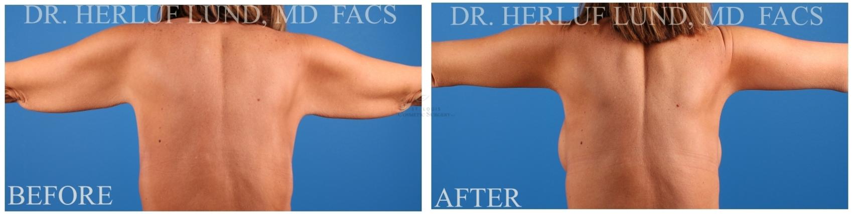 Before & After Arm Liposuction Case 380 Back View in St. Louis, MO