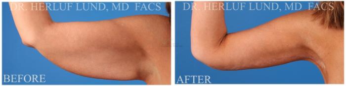 Before & After Arm Lift Case 380 Left Side View in St. Louis, MO