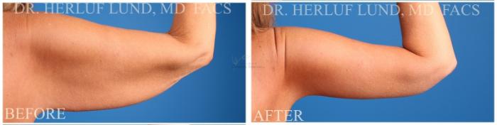 Before & After Arm Lift Case 380 Right Side View in St. Louis, MO