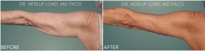 Before & After Arm Lift Case 387 Left Arm Straight View in St. Louis, MO